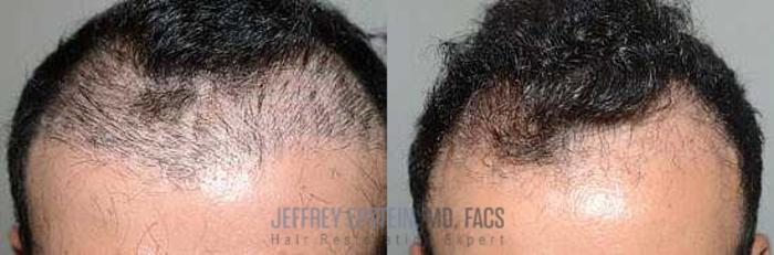 Before & After Hair Transplant Repair Case 14 View 2 View in Miami, FL