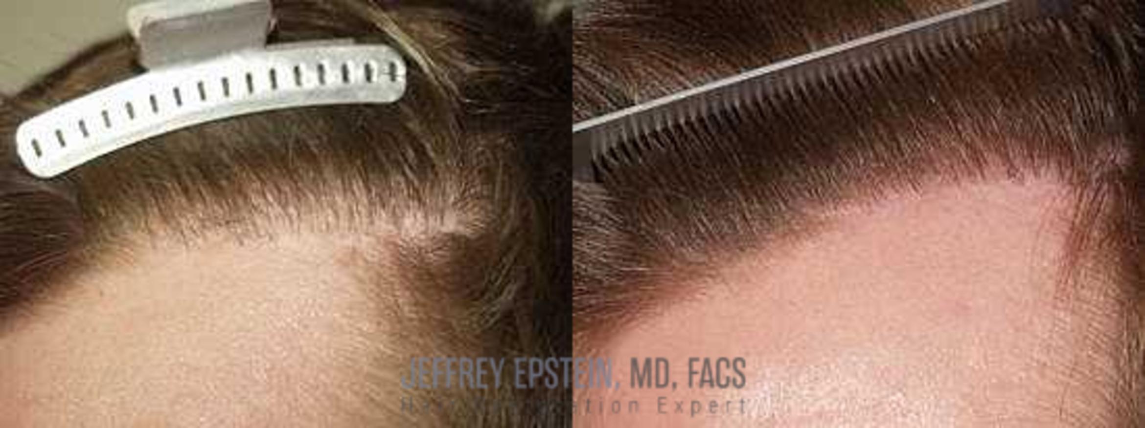 Before & After Hair Transplant Repair Case 147 View 1 View in Miami, FL