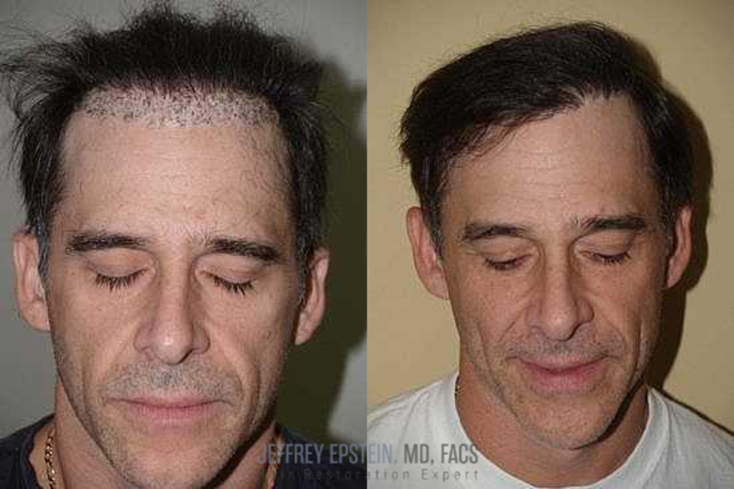 Before & After Hair Transplant Repair Case 148 View 2 View in Miami, FL