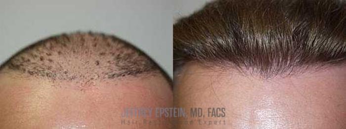 Before & After Hair Transplant Repair Case 150 View 1 View in Miami, FL