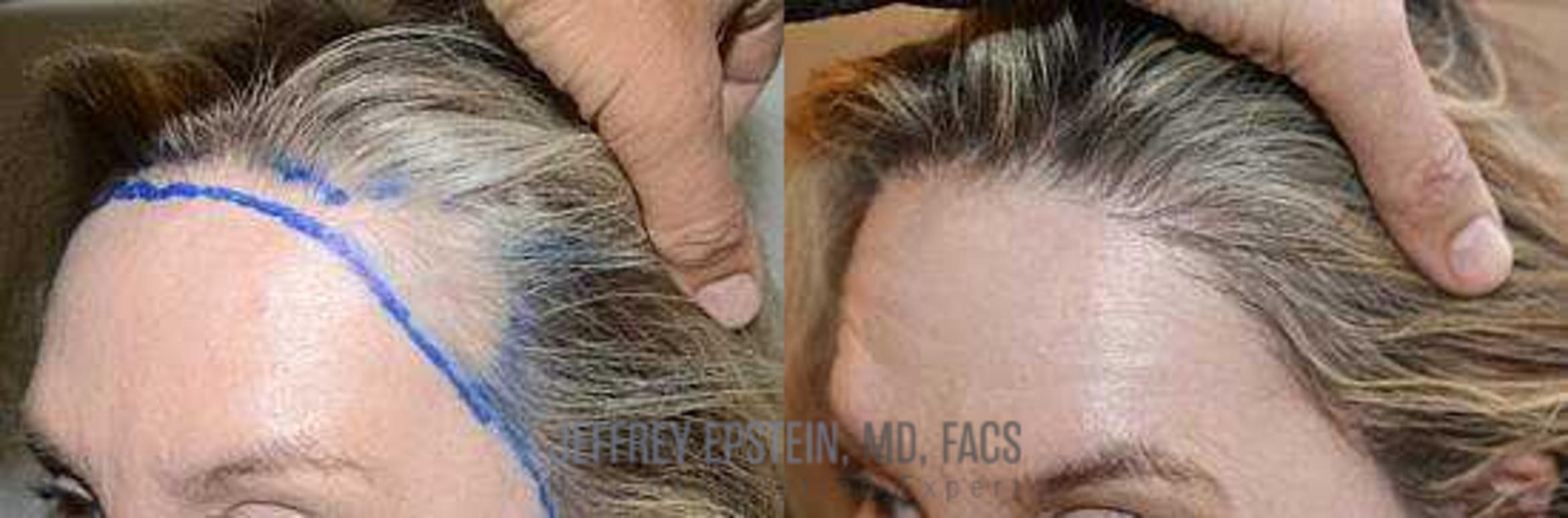 Before & After Hair Transplant Repair Case 161 View 2 View in Miami, FL