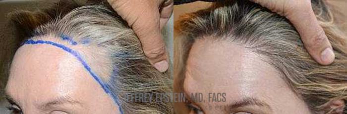 Before & After Hair Transplant Repair Case 161 View 2 View in Miami, FL