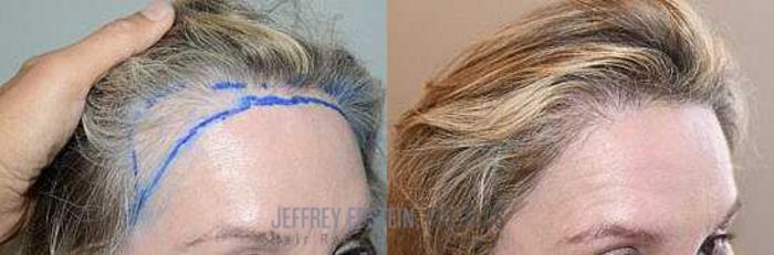 Before & After Hair Transplant Repair Case 161 View 3 View in Miami, FL