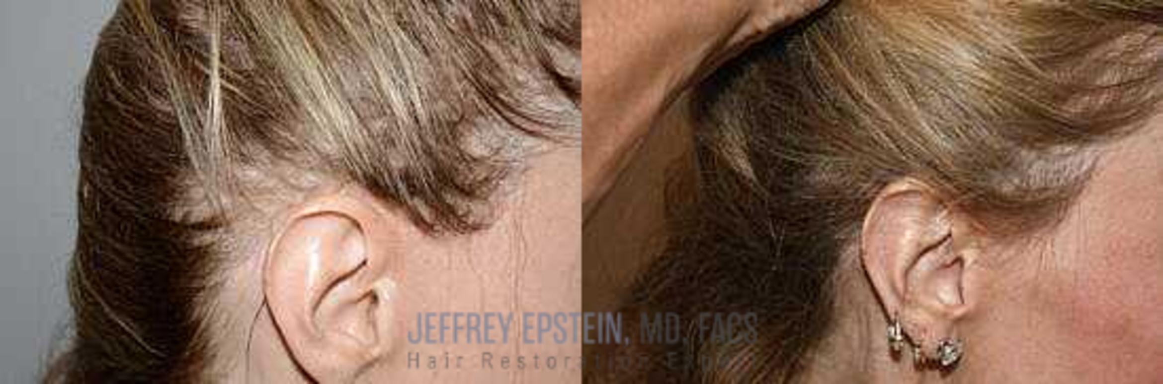 Before & After Hair Transplant Repair Case 167 View 2 View in Miami, FL