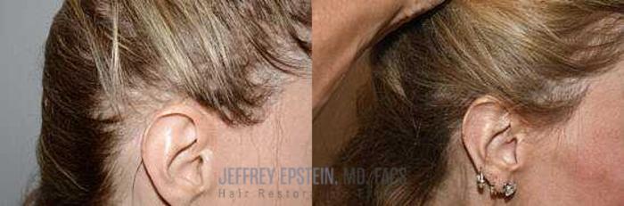 Before & After Hair Transplant Repair Case 167 View 2 View in Miami, FL