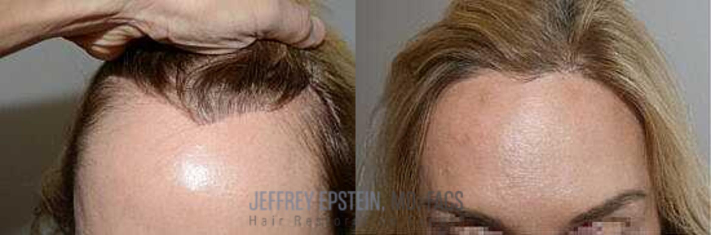 Before & After Hair Transplant Repair Case 167 View 3 View in Miami, FL