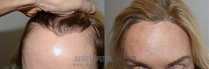 Before & After Hair Transplant Repair Case 167 View 3 View in Miami, FL
