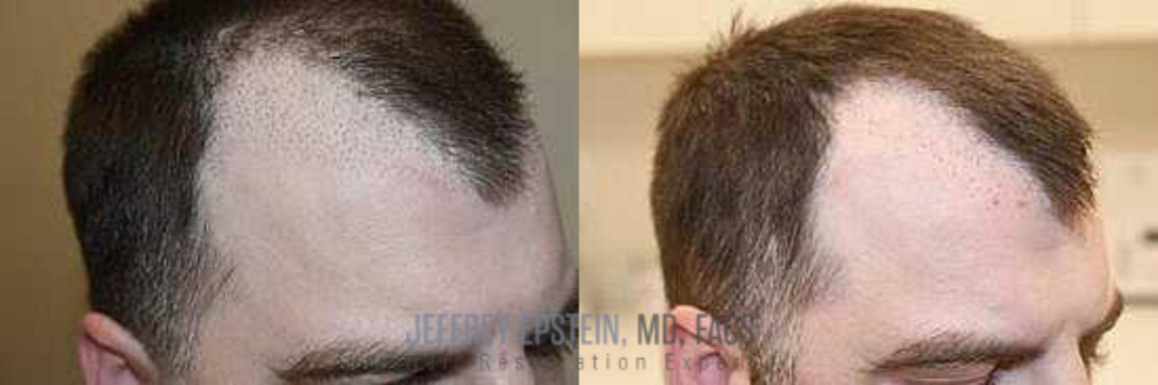 Before & After Hair Transplant Repair Case 24 View 1 View in Miami, FL