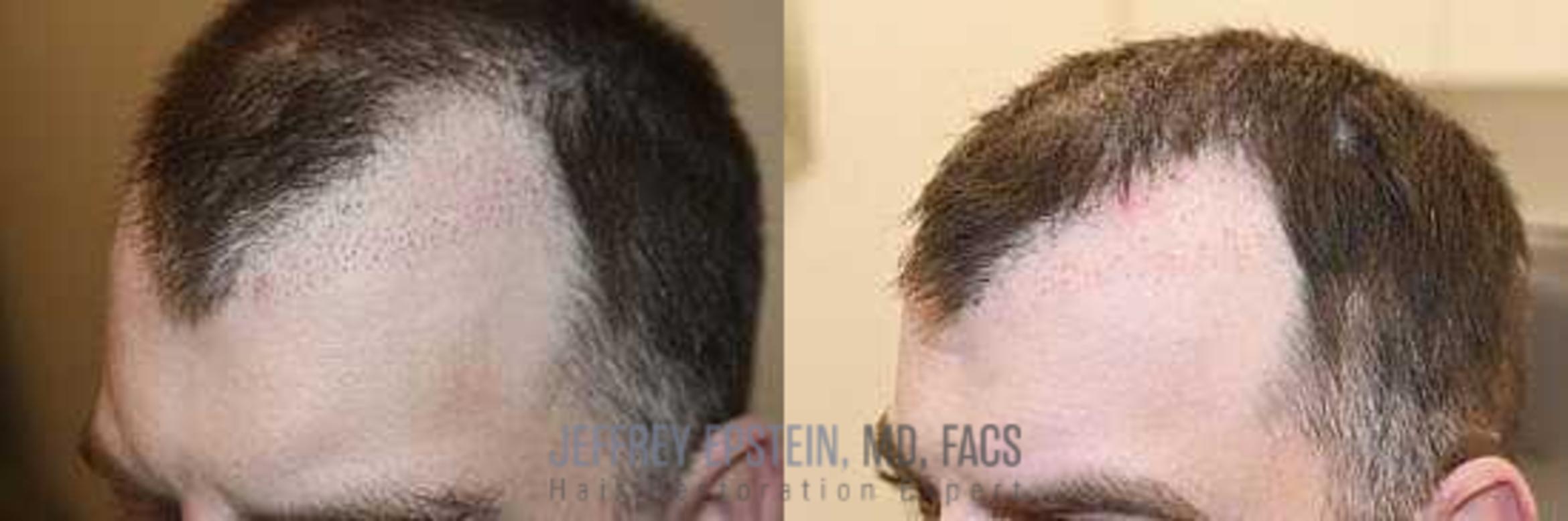 Before & After Hair Transplant Repair Case 24 View 2 View in Miami, FL