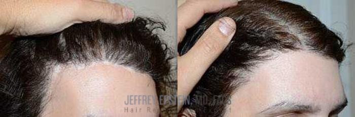 Before & After Hair Transplant Repair Case 294 View 3 View in Miami, FL