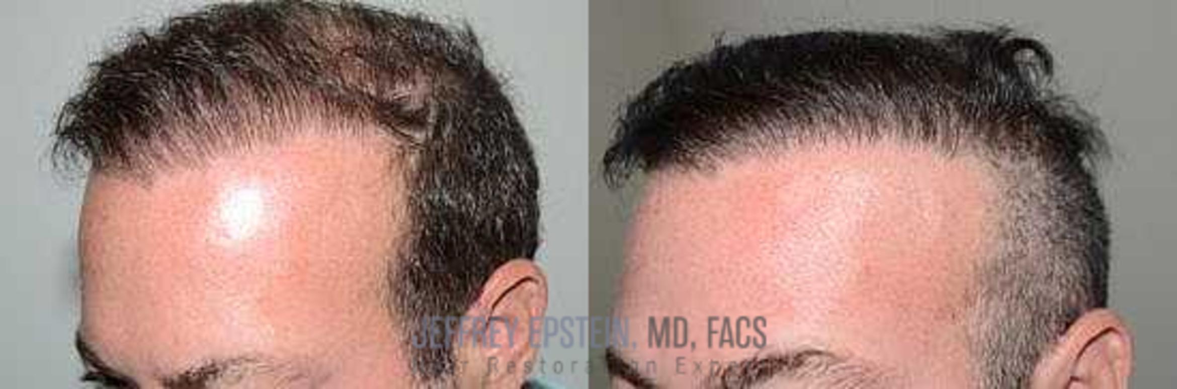 Before & After Hair Transplant Repair Case 31 View 1 View in Miami, FL