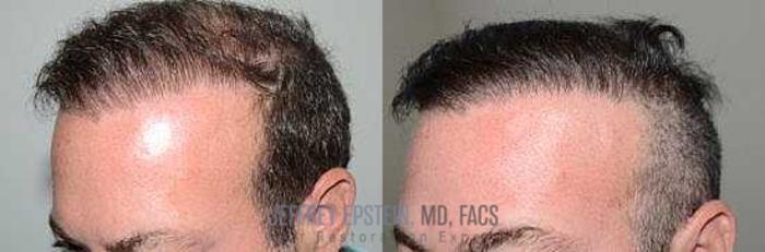 Before & After Hair Transplant Repair Case 31 View 1 View in Miami, FL