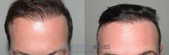 Before & After Hair Transplant Repair Case 31 View 2 View in Miami, FL