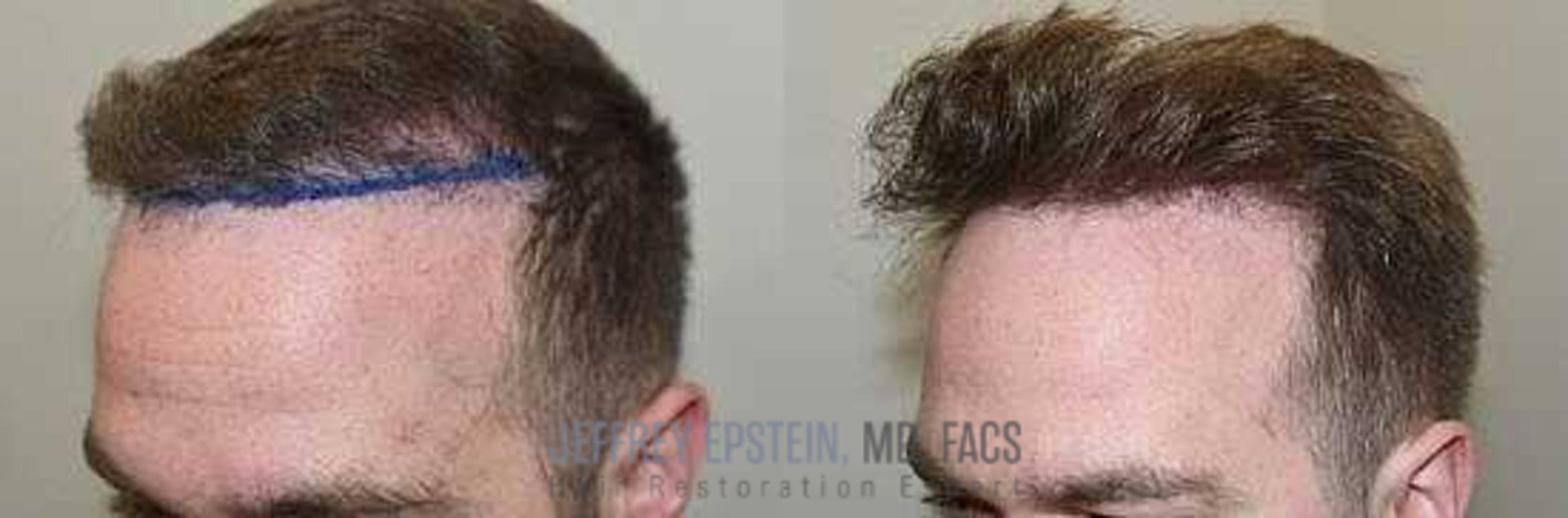 Before & After Hair Transplant Repair Case 38 View 1 View in Miami, FL