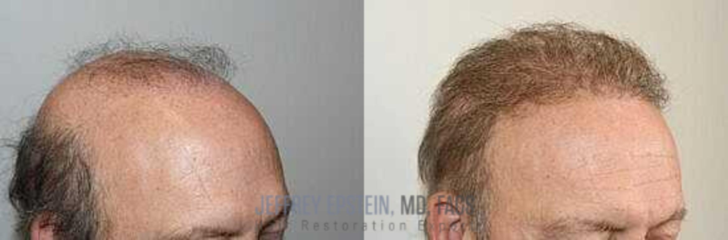 Before & After Hair Transplant Repair Case 5 View 2 View in Miami, FL