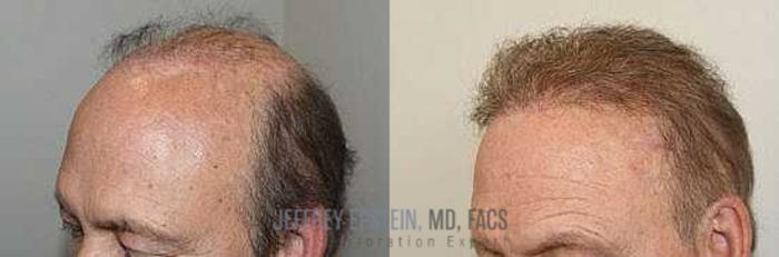 Before & After Hair Transplant Repair Case 5 View 3 View in Miami, FL
