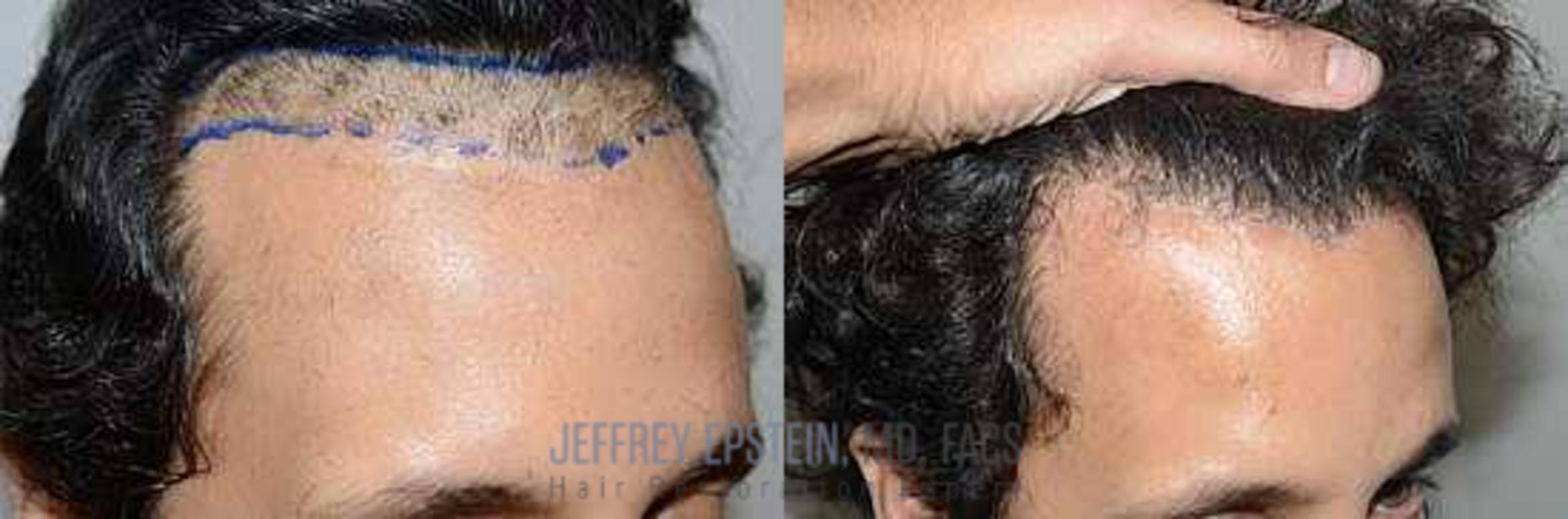 Before & After Hair Transplant Repair Case 69 View 1 View in Miami, FL