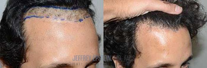 Before & After Hair Transplant Repair Case 69 View 1 View in Miami, FL