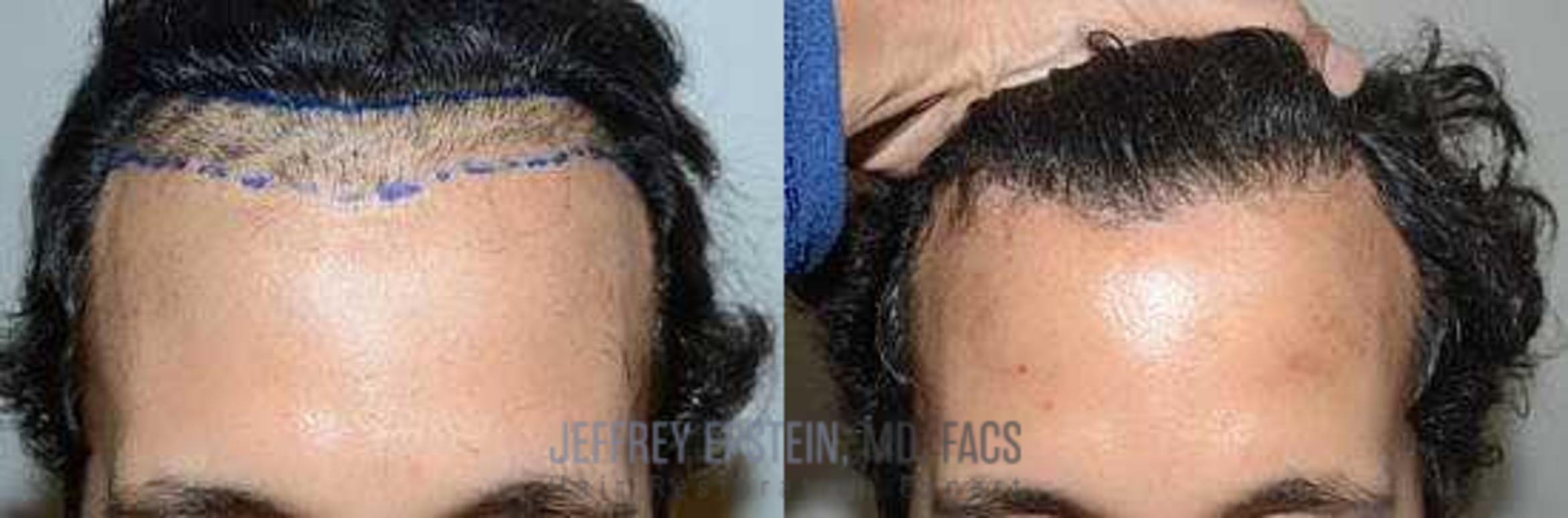 Before & After Hair Transplant Repair Case 69 View 2 View in Miami, FL