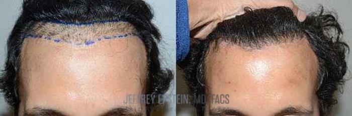 Before & After Hair Transplant Repair Case 69 View 2 View in Miami, FL
