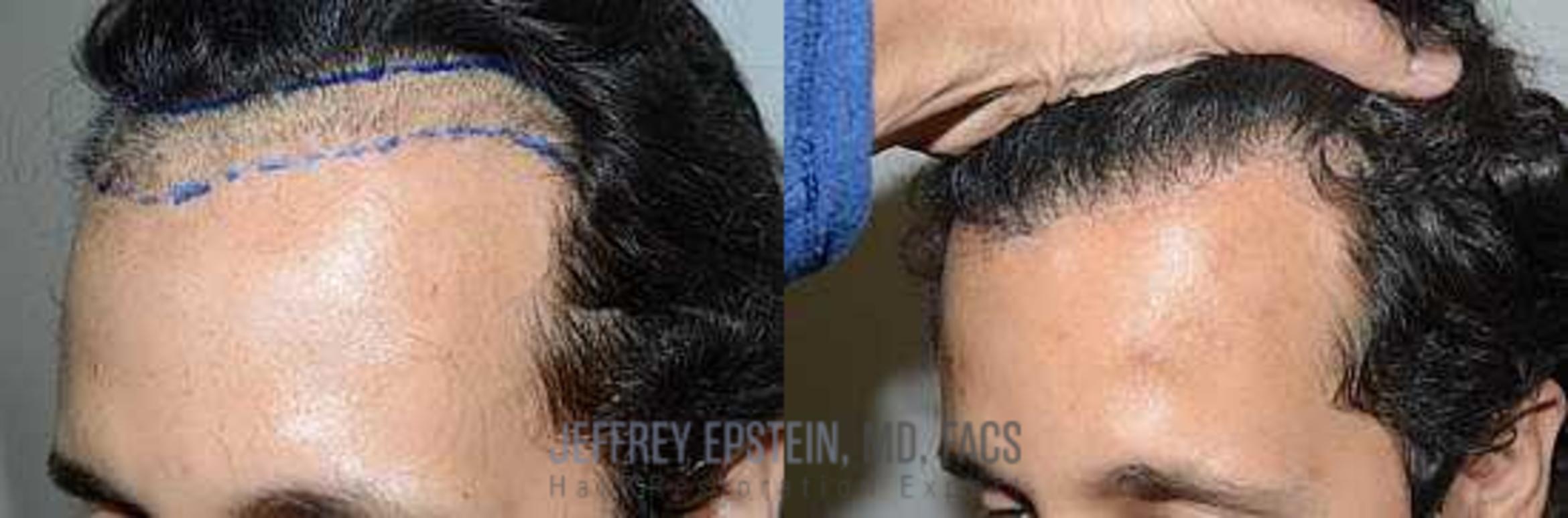 Before & After Hair Transplant Repair Case 69 View 3 View in Miami, FL