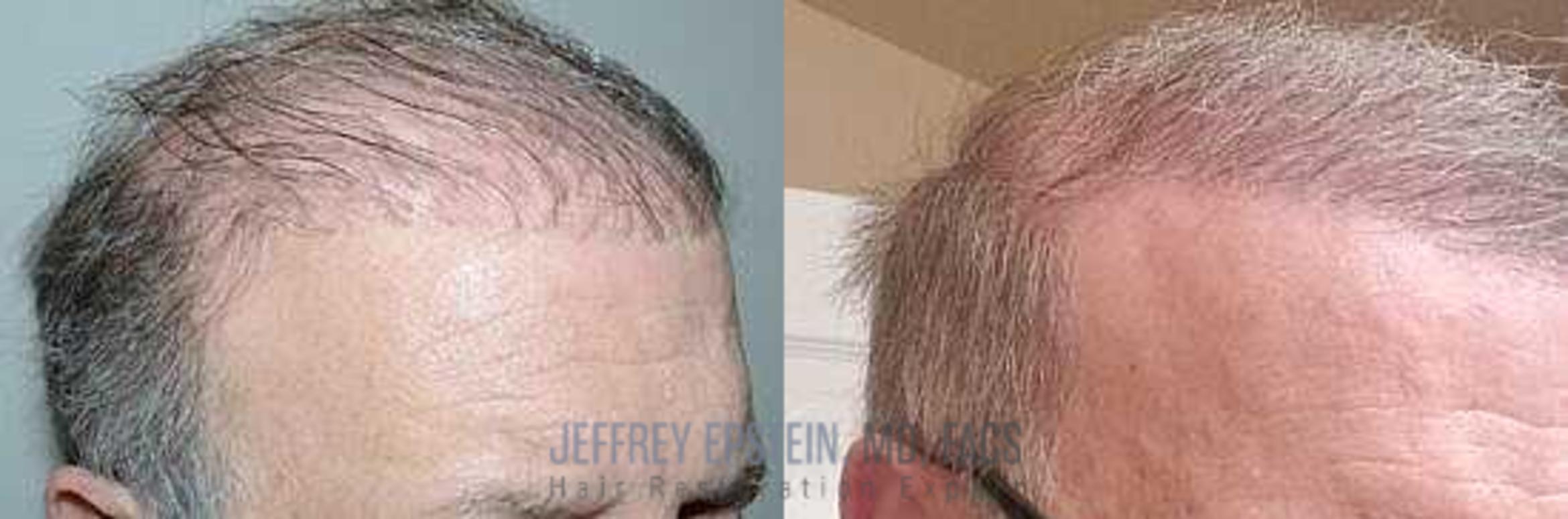 Before & After Hair Transplant Repair Case 70 View 1 View in Miami, FL
