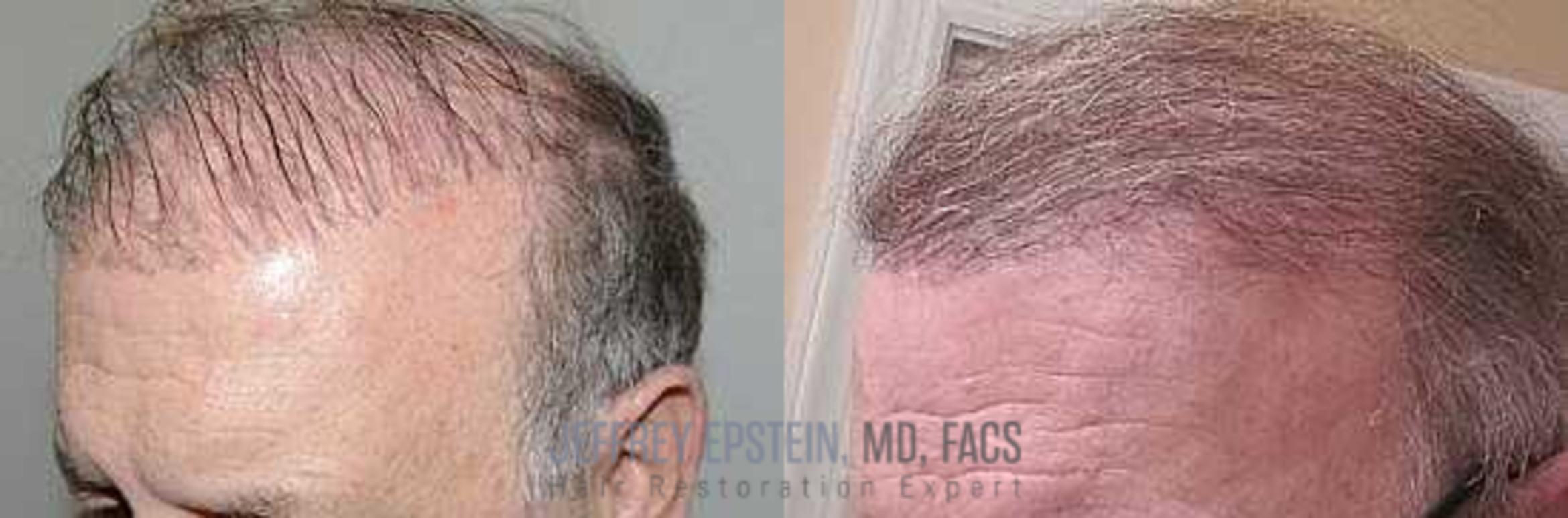 Before & After Hair Transplant Repair Case 70 View 2 View in Miami, FL