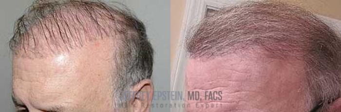 Before & After Hair Transplant Repair Case 70 View 2 View in Miami, FL