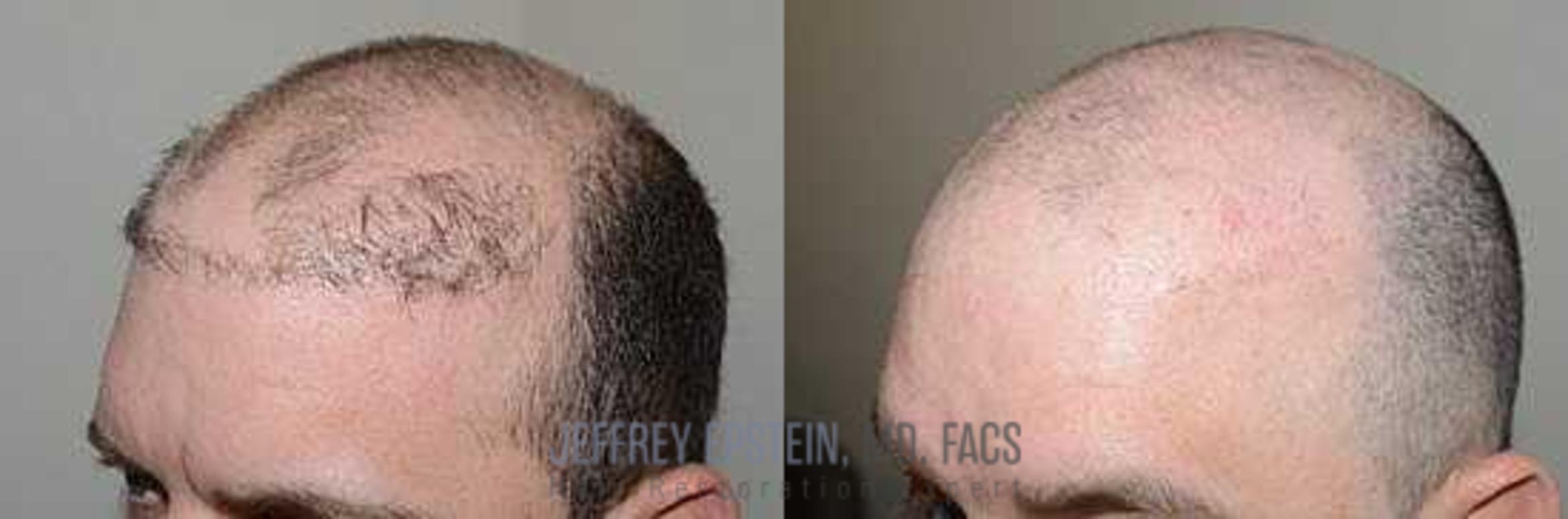 Before & After Hair Transplant Repair Case 72 View 1 View in Miami, FL