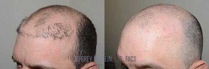 Before & After Hair Transplant Repair Case 72 View 1 View in Miami, FL