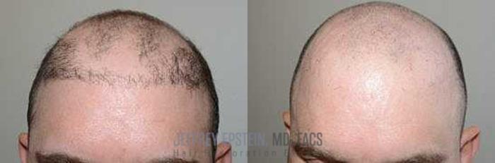 Before & After Hair Transplant Repair Case 72 View 2 View in Miami, FL