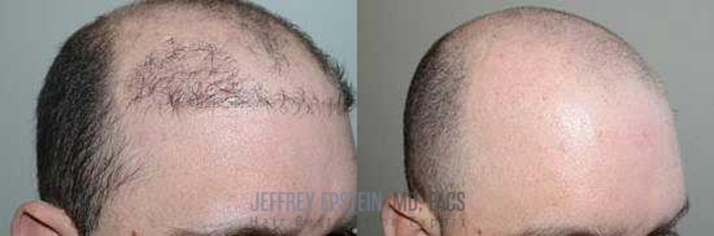 Before & After Hair Transplant Repair Case 72 View 3 View in Miami, FL
