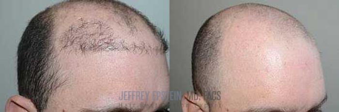 Before & After Hair Transplant Repair Case 72 View 3 View in Miami, FL