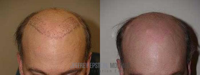 Before & After Body Hair Transplant (BHT) Case 74 View 1 View in Miami, FL