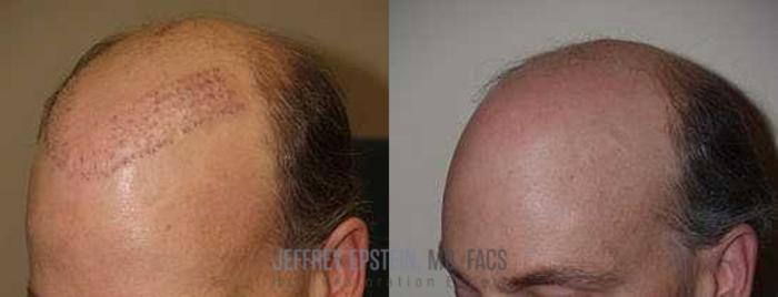 Before & After Hair Transplant Repair Case 74 View 2 View in Miami, FL