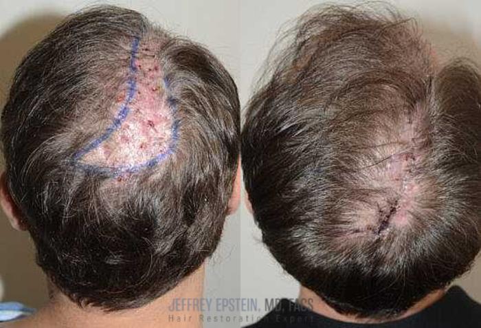 Before & After Hair Transplant Repair Case 87 View 1 View in Miami, FL