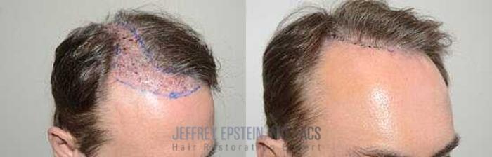 Before & After Hair Transplant Repair Case 87 View 2 View in Miami, FL