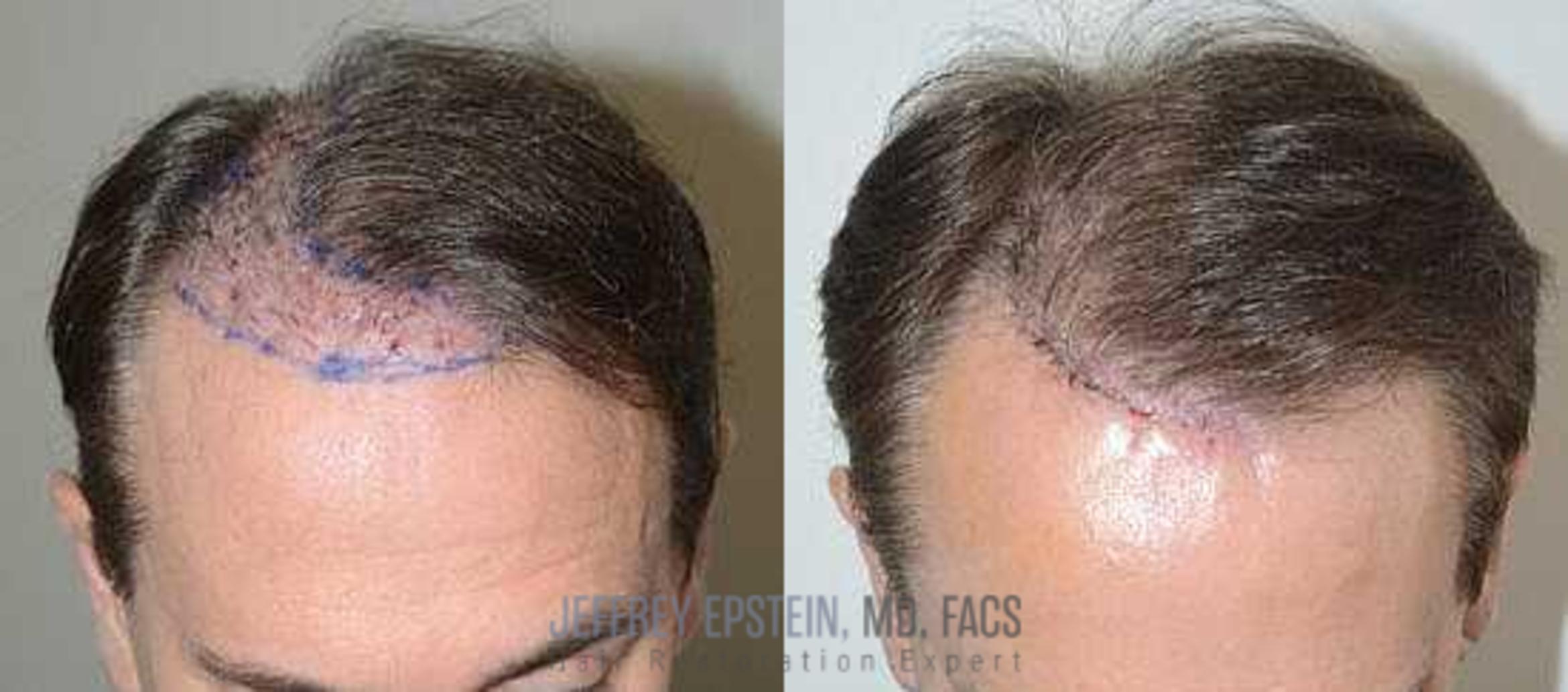 Before & After Hair Transplant Repair Case 87 View 3 View in Miami, FL