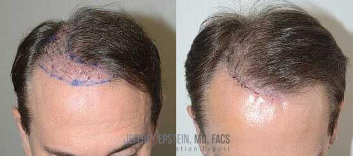 Before & After Hair Transplant Repair Case 87 View 3 View in Miami, FL