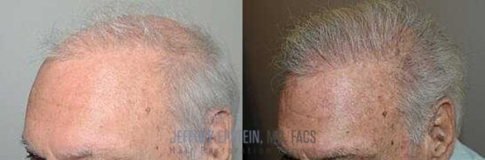 Before & After Body Hair Transplant (BHT) Case 9 View 1 View in Miami, FL
