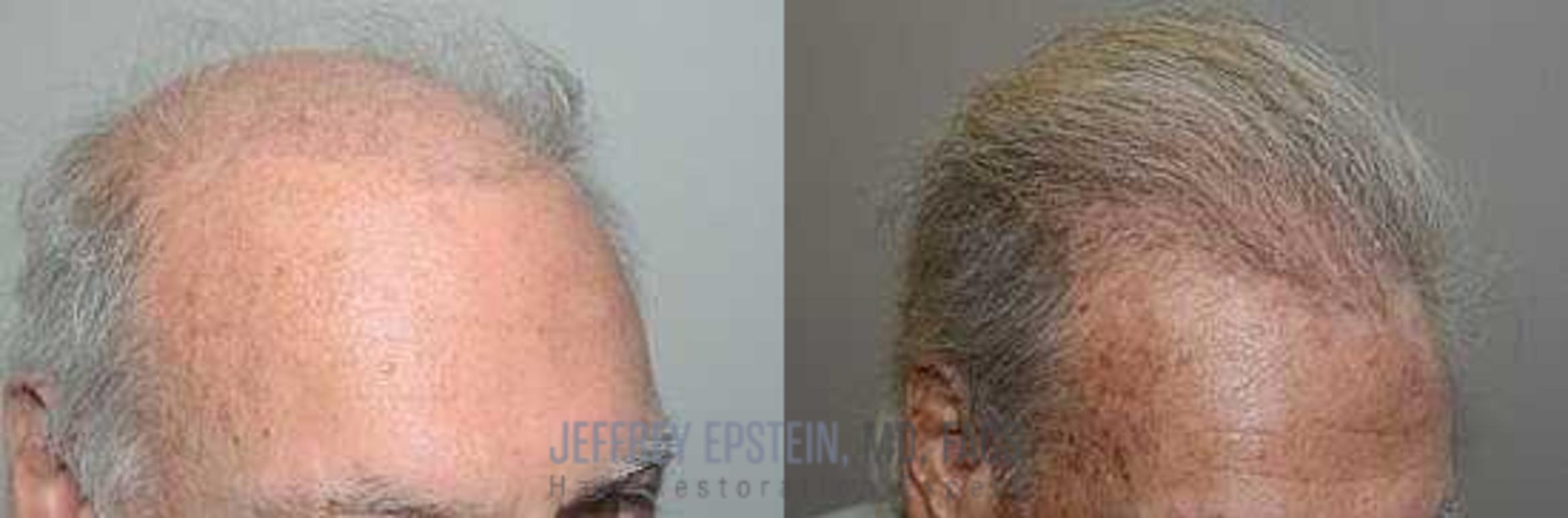 Before & After Hair Transplant Repair Case 9 View 2 View in Miami, FL