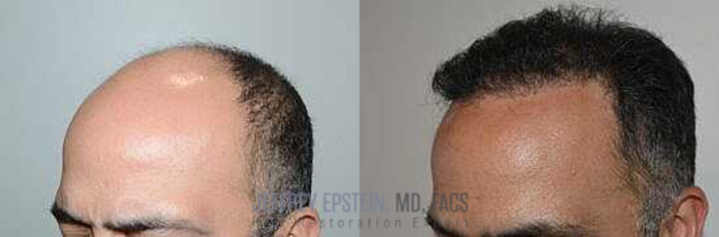 Before & After Hair Transplants For Men Case 1 View 2 View in Miami, FL