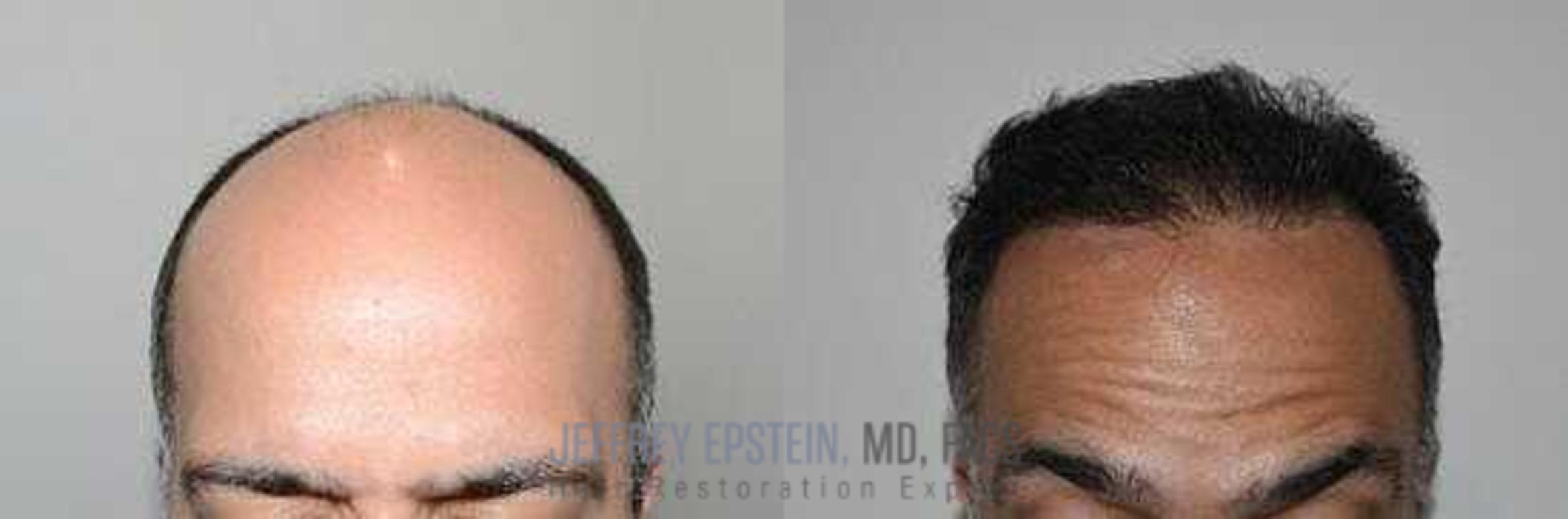 Before & After Hair Transplants For Men Case 1 View 3 View in Miami, FL