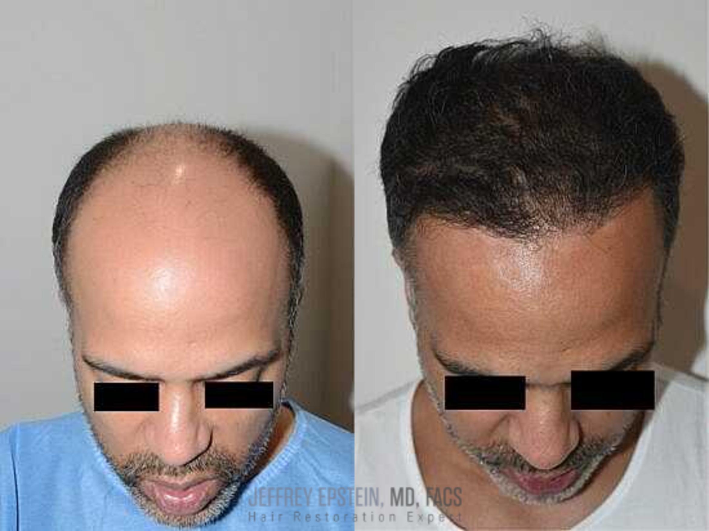 Before & After Hair Transplants For Men Case 1 View 4 View in Miami, FL