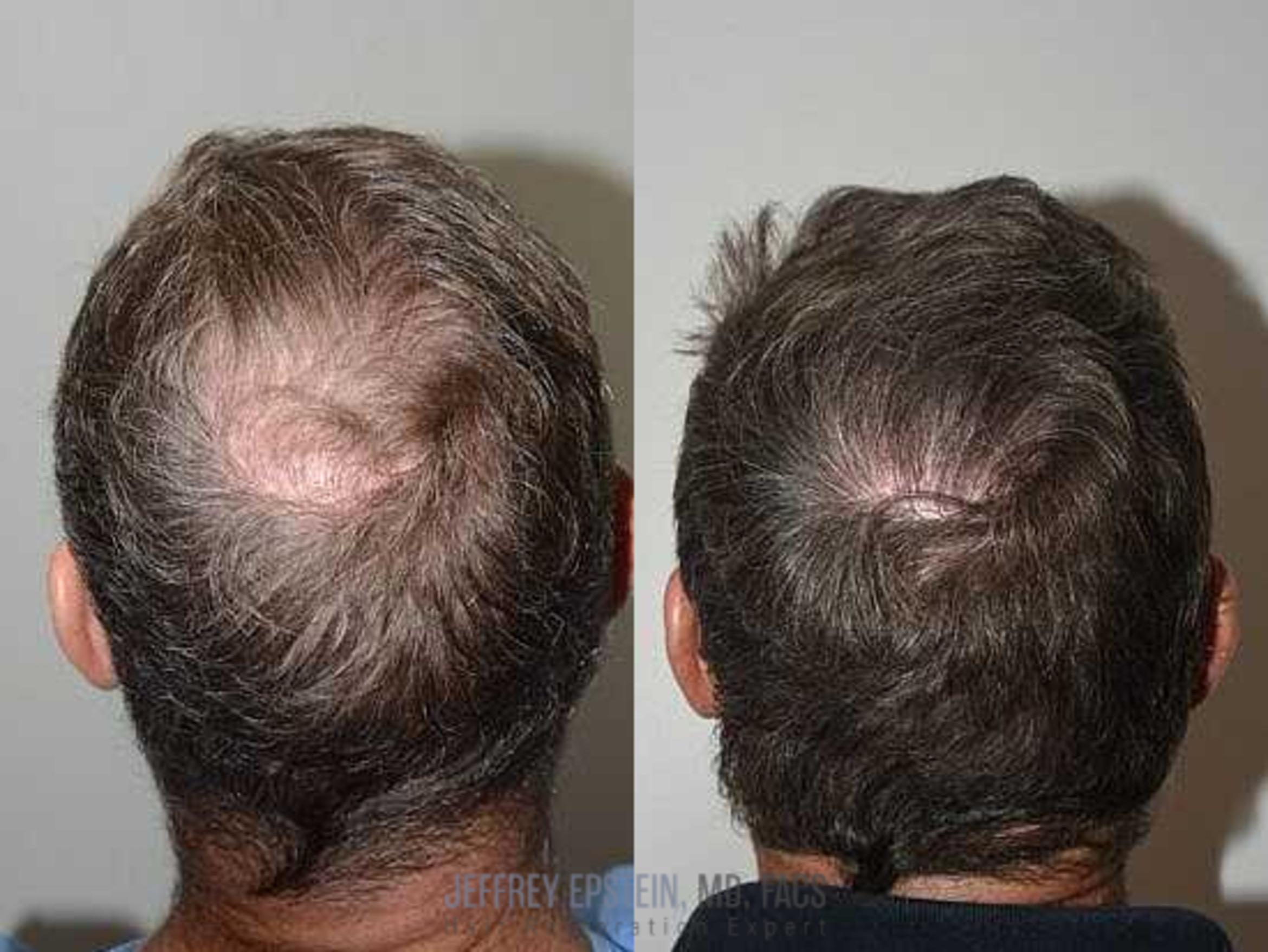 Before & After Hair Transplants For Men Case 10 View 1 View in Miami, FL