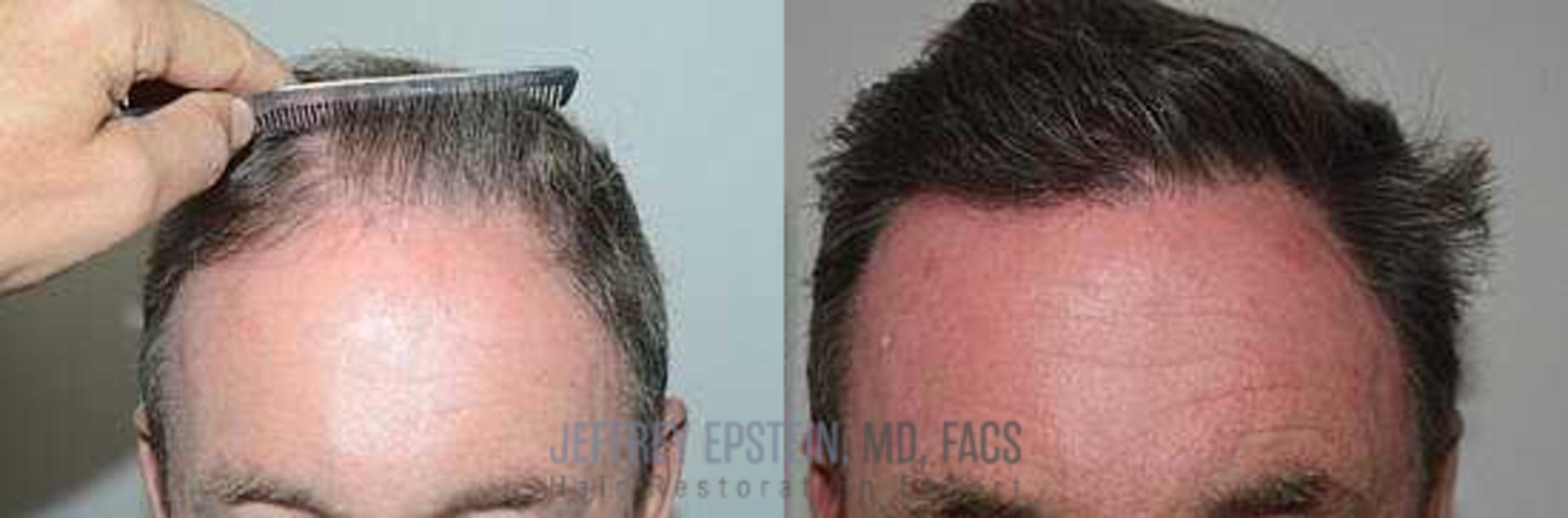 Before & After Hair Transplants For Men Case 10 View 2 View in Miami, FL