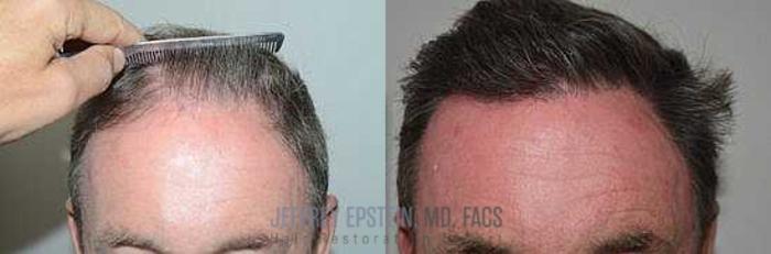 Before & After Hair Transplants For Men Case 10 View 2 View in Miami, FL