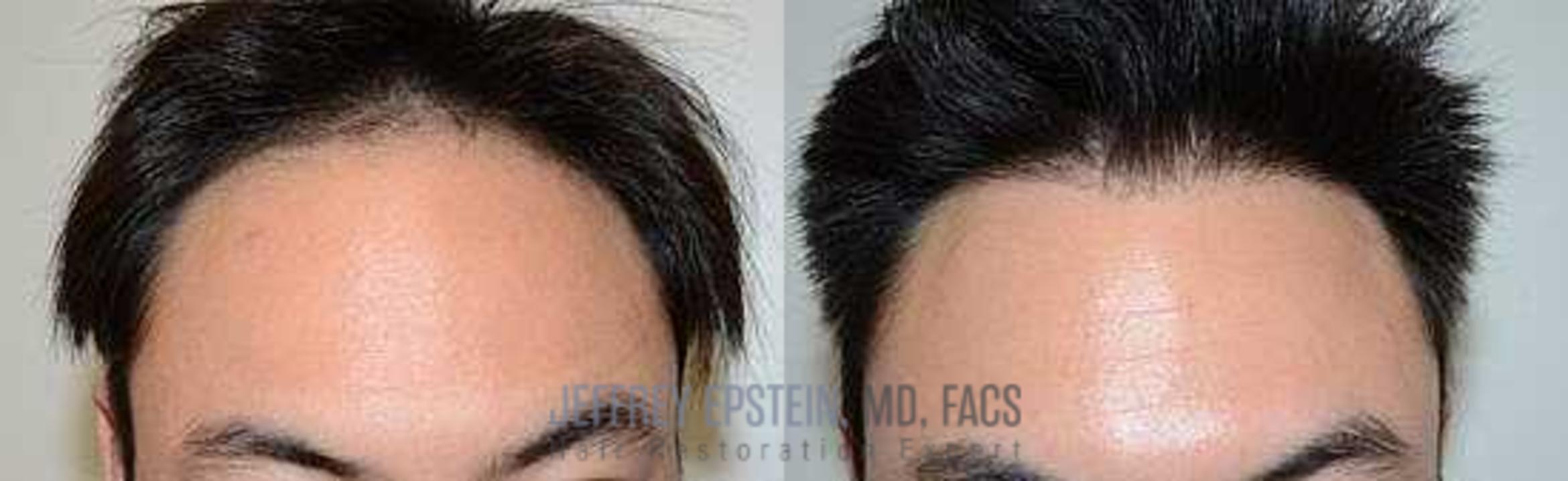Before & After Hair Transplants For Men Case 100 View 1 View in Miami, FL