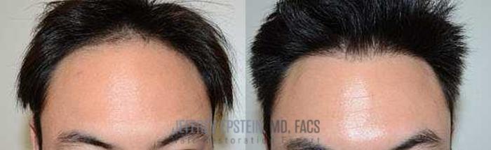 Before & After Hair Transplants For Men Case 100 View 1 View in Miami, FL