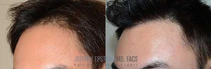 Before & After Hair Transplants For Men Case 100 View 2 View in Miami, FL